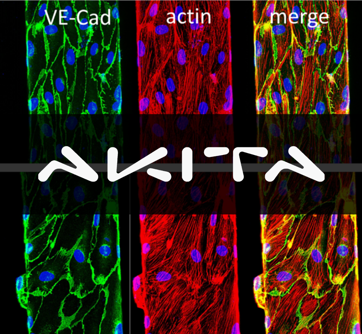 AKITA 3D血管模型1 | 靜脈畸形（VMs）