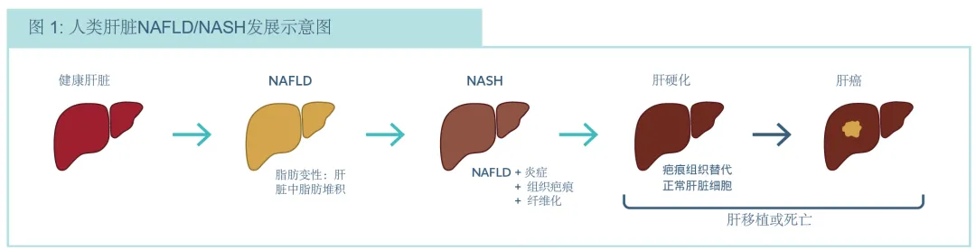 人類肝臟NAFLD/NASH發展示意圖